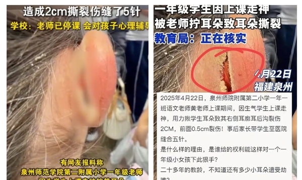 福建一年级女童上课走神 遭老师揪耳 撕裂2厘米