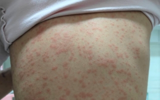 部桃：红疹非过敏 EB病毒作怪引起化脓性扁桃腺炎