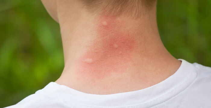 被蚊子叮咬如何止痒? 简单10招快学起来