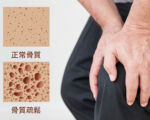 【鄧醫談養生】骨質疏鬆吃鈣片？