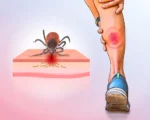 被蜱虫叮了怎么办？警惕莱姆病的致命伪装