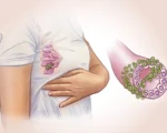 乳腺癌十大早期征兆、风险因素与预防方法