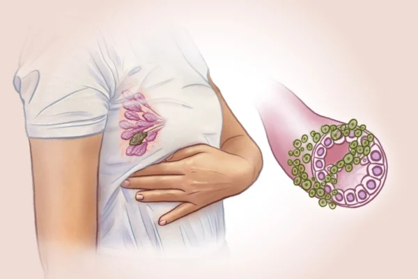 乳腺癌十大早期征兆、风险因素与预防方法