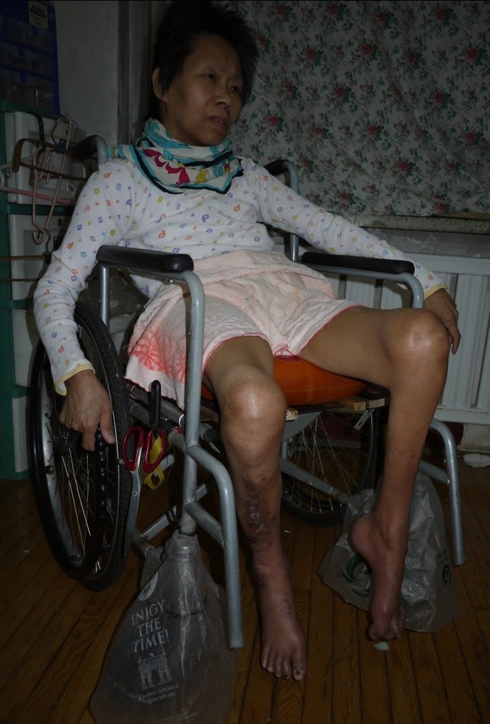 叶旭霞因不放弃修炼法轮功,在中共劳教所被殴打致重伤,导致残疾和瘫痪。(图片由叶旭霞女儿提供)