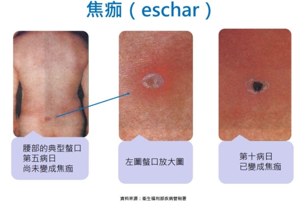 扫墓踏青防恙虫 桃园卫生局呼吁做好防护安心游