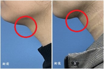「經口內視鏡頸部拉皮手術」,協助改善雙下巴、頸部鬆弛,並修飾下頷與頸部輪廓.