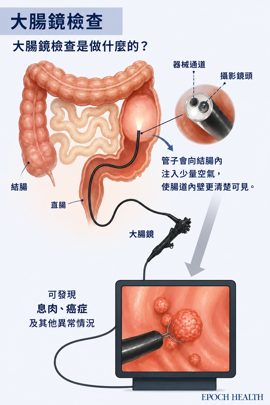 從器械通道、攝影鏡頭到螢幕上的即時影像,大腸鏡讓醫師在檢查的同時,就能對息肉採取行動。這是糞便潛血等其他篩檢工具做不到的事。(Shutterstock/大紀元製圖)
