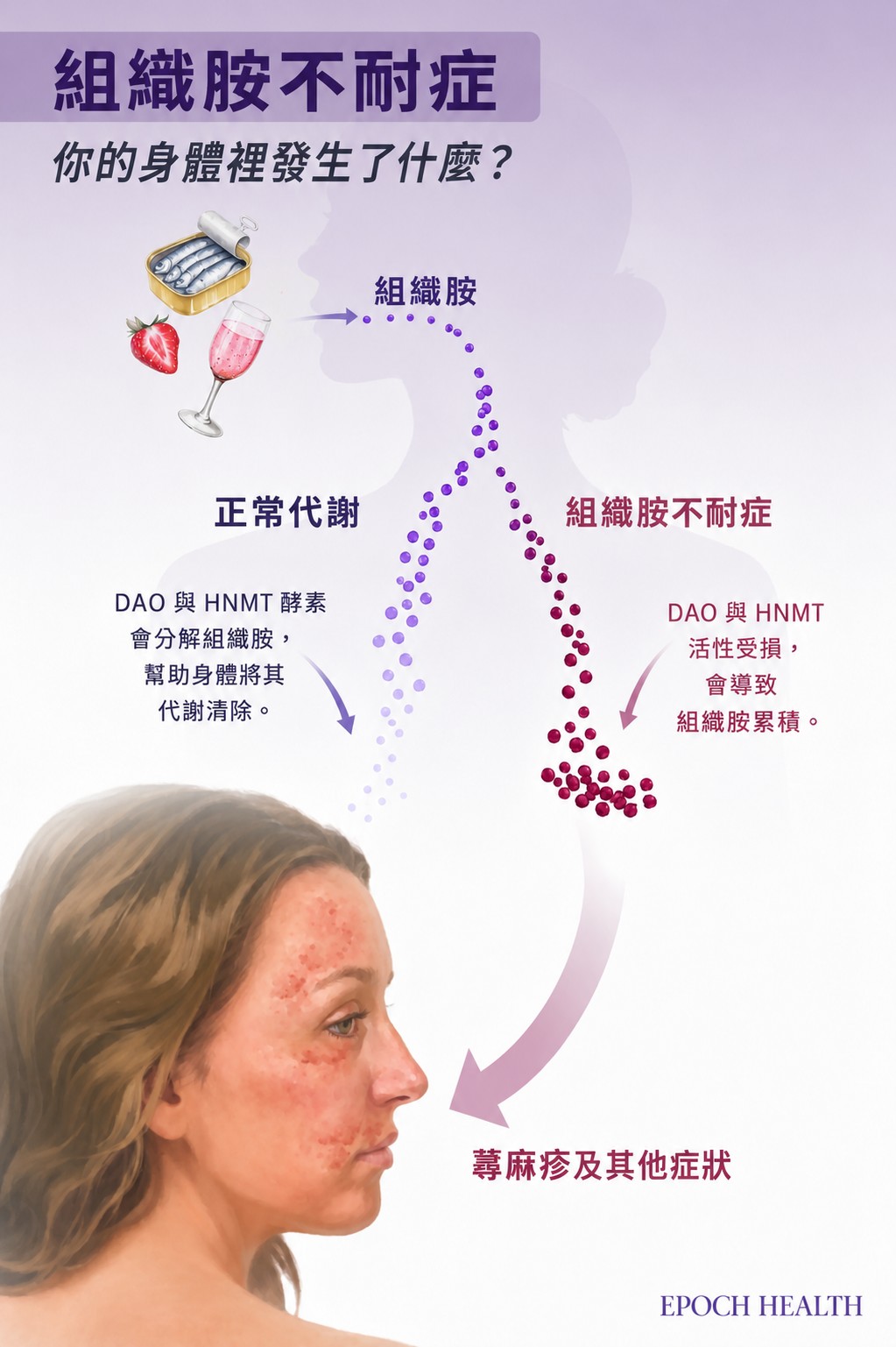 正常情況下,DAO與HNMT酵素會將組織胺分解清除;當這兩種酵素的活性受損,組織胺在體內累積,蕁麻疹和其他多系統症狀就隨之而來。(The Epochtimes, Shutterstock)