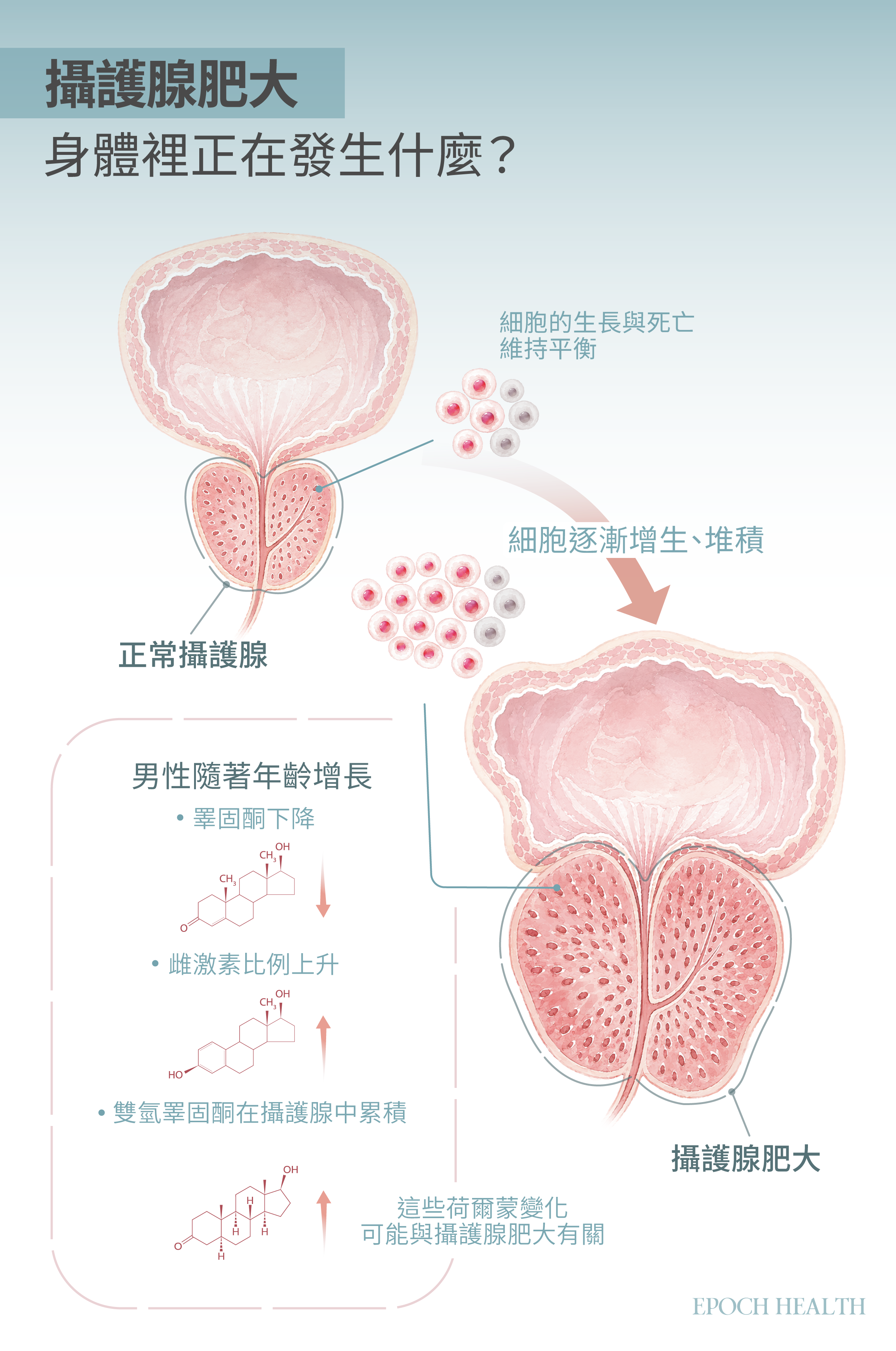 正常情況下,攝護腺細胞的新生與凋亡會維持平衡。但隨著年齡增加,睪固酮下降,雌激素比例升高,雙氫睪固酮又持續在攝護腺裡累積,這幾項荷爾蒙的轉變打破了原本的平衡,細胞便逐漸增生堆積,攝護腺也就跟著變大。(Shutterstock/大紀元製圖)