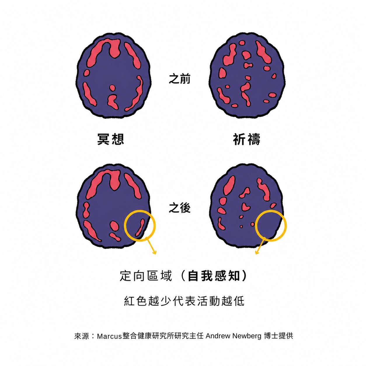 腦部掃描對比圖顯示,冥想與祈禱前後,大腦「定向區域」(負責自我感知與空間定位的頂葉區域)的活動程度均有所下降,紅色區塊愈少,代表該區域活動愈低,與練習者描述的「自我感消融」體驗相呼應。(來源:Marcus整合健康研究所研究主任 Andrew Newberg 博士)