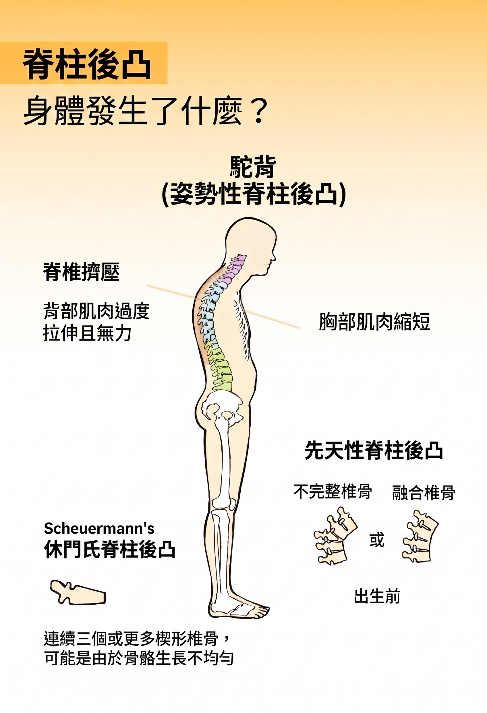 脊椎後凸往往會隨年齡增加而變得更加明顯。 (大紀元製圖)